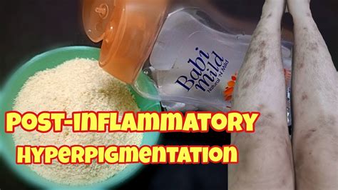 Post Inflammatory Hyperpigmentation How To Get Rid Of Mosquito Bites