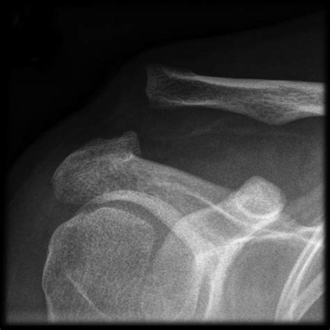 Acromioclavicular Ac Joint Injuries