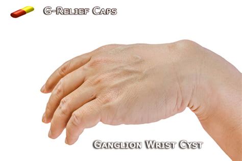 Ganglion Wrist Cyst Disappears After Taking The Natural G Relief Super Caps