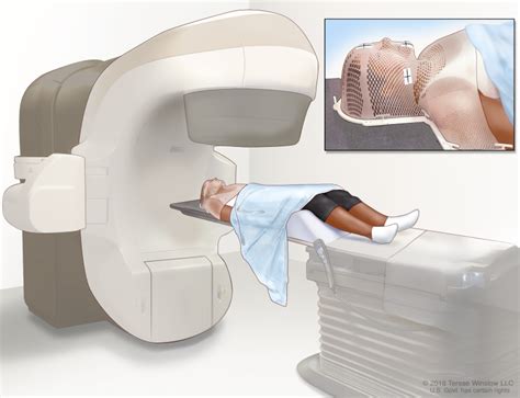 Figure External Beam Radiation Therapy Of The PDQ Cancer Information Summaries NCBI