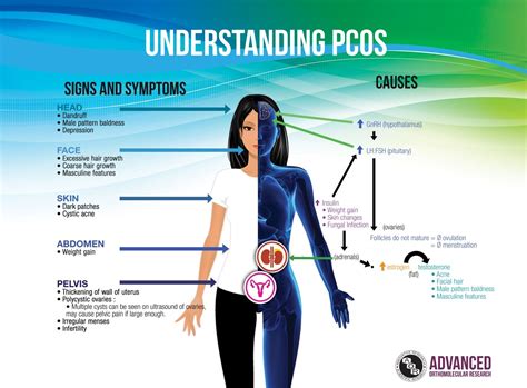 Polycystic ovarian syndrome (pcos) is a group of symptoms caused by a hormone disorder. Know the Symptoms of Polycystic Ovarian Syndrome