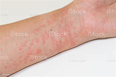 Hives On Arm Stock Photo Download Image Now Allergy Skin Human