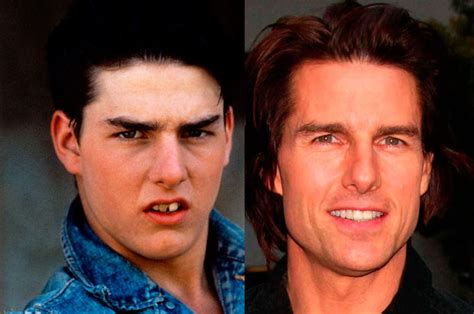 10 Celebs Who Used To Have Horrible Smiles Photo Canada Journal