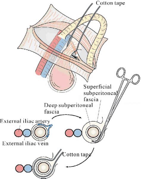 Femoral Hernia A Review Of The Clinical Anatomy And Surgical Treatment Semantic Scholar