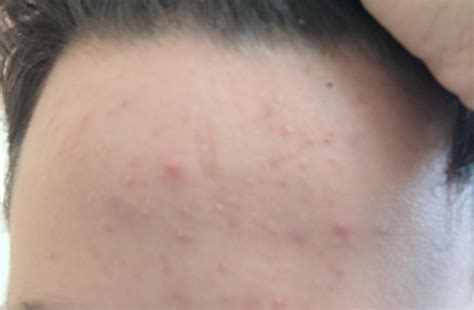 I Have All These Little Bumps On My Forehead How Do I Get Rid Of Them