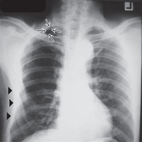Check spelling or type a new query. Unrecognized Hemo-Pneumothorax from Major Chest Injury ...