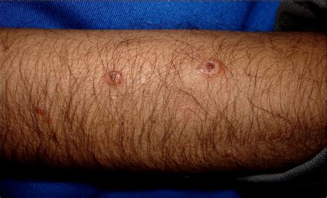 Skin Lesions In Histoplasmosis Clinics In Dermatology