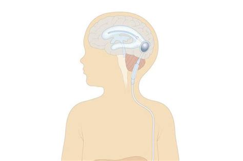 Shunt Placement For Hydrocephalus Or Water On The Brain