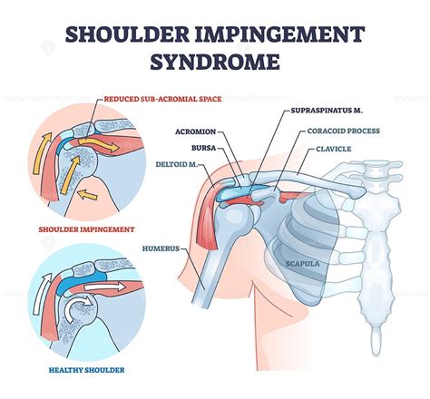 Shoulder Impingement Syndrome From Rubbing Rotator Cuff Outline Diagram Vectormine