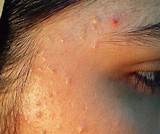 Sandpaper Acne Treatment Pictures