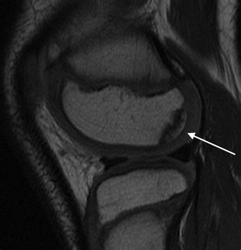 Evolution Of Femoral Condylar Ossification At Mr Imaging Frequency And