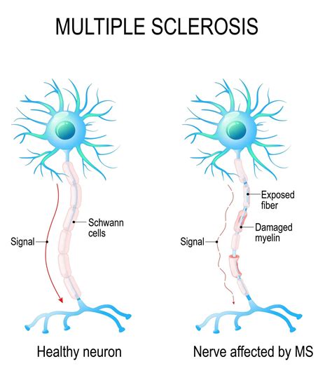Differential diagnosis of suspected multiple sclerosis: Multiple Sclerosis|Wellness Guru Australia