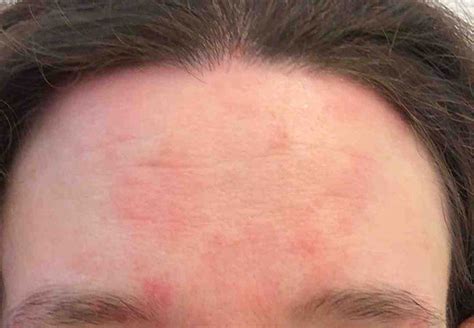 Seborrheic Dermatitis Red Patches On Face Treatment Skin