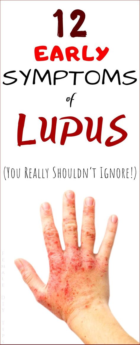 12 Early Symptoms Of Lupus You Really Shouldnt Ignore Signs Of