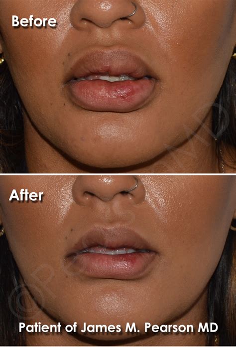 Lip Reduction Photos Before After Dr James Pearson Facial