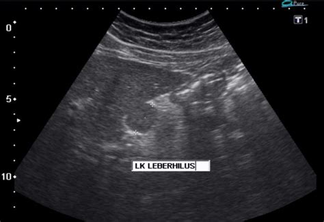 Splenic Marginal Zone Lymphoma Ultrasound Wikidoc