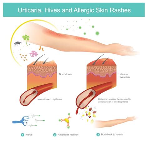 What Causes Hives And How Dangerous Can They Be A Nurse Practitioner Explains