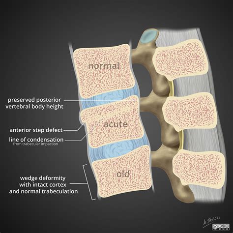 Spinal compression fracture: acute vs old | Image ...