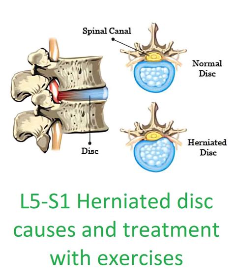 Herniated Disc