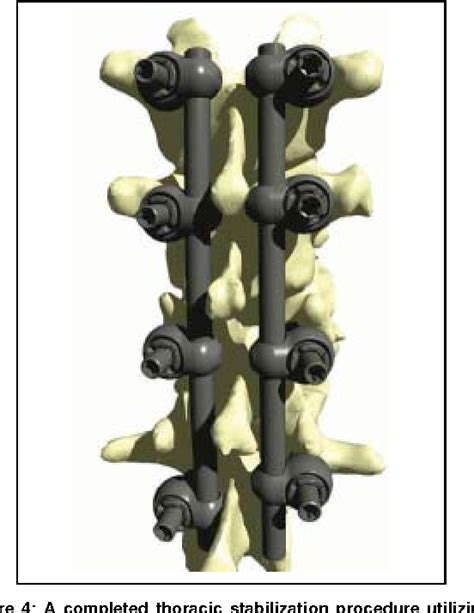 Figure From Posterior Thoracic Segmental Pedicle Screw Instrumentation Evolving Methods Of