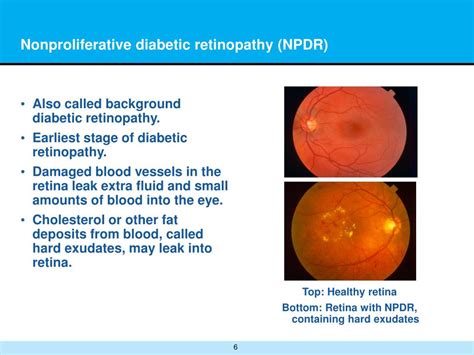 Ppt Diabetic Retinopathy Powerpoint Presentation Free Download Id