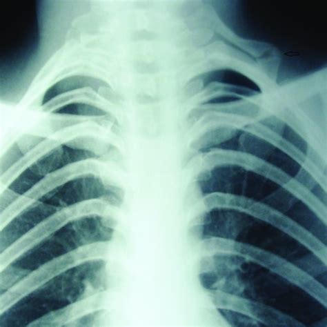 X Ray Of Chest And Cervical Spine Pa View Showing Left Cervical Rib