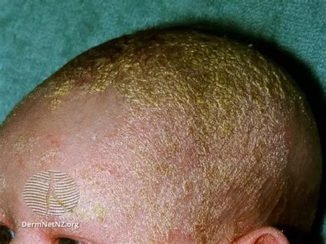 Symptoms And Photos Of Seborrheic Dermatitis On The Face Scalp And