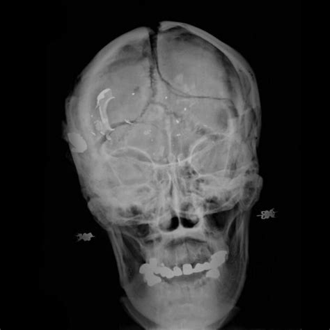 Gunshot Wound To Head Radiology Case Medical