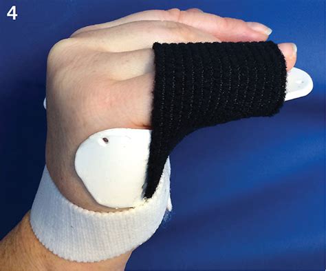Aspetar Sports Medicine Journal Rehabilitation Of The Hand