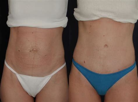 Belly Button Bleeding After Tummy Tuck Cosmetic Surgery Tips