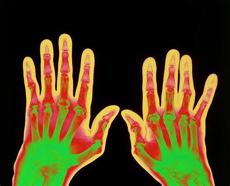 Rheumatoid arthritis can be difficult to diagnose in its early stages because the early signs and symptoms mimic those of many other diseases. Coloured X-ray Of Hands With Rheumatoid Arthritis ...