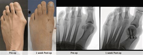 Keyhole Bunion Surgery Perth Dr Andrew Knox Perth Podiatric Surgery