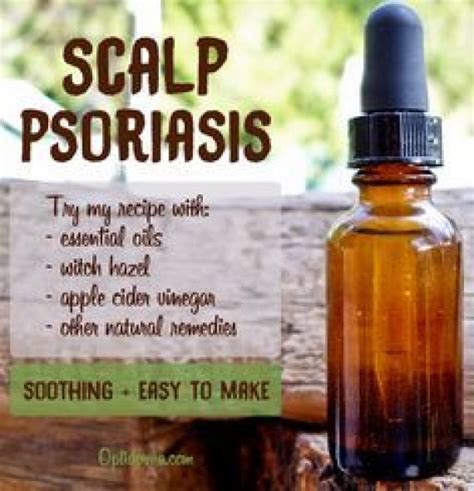 Scalp Psoriasis Can Be Very Annoying And Embarrassing I Find This