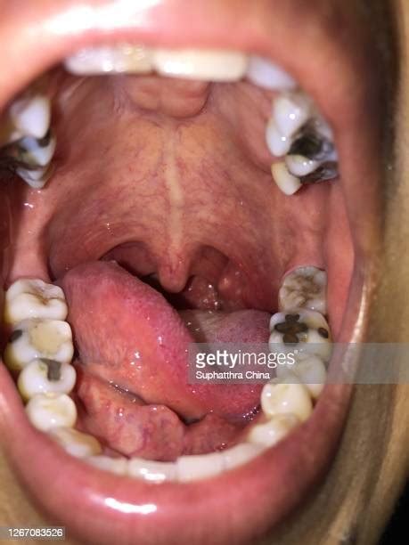 Swollen Tonsils Photos And Premium High Res Pictures Getty Images