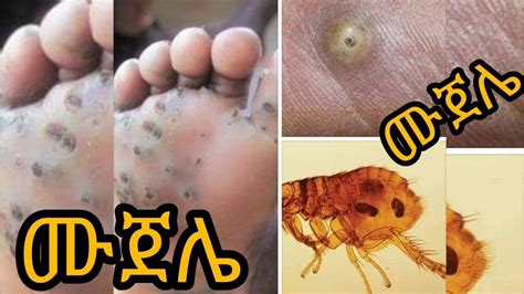 DefeatNTDs Tungiasis ሙጀሌ a neglected tropical skin disease by Lynne Elson YouTube