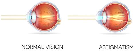 Astigmatism What Is It Causes And Treatment