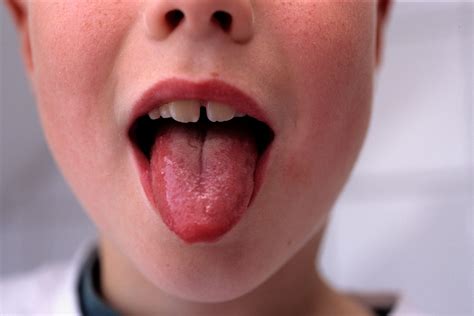 What Is Scarlet Fever Symptoms Rash How It Spreads And Affects