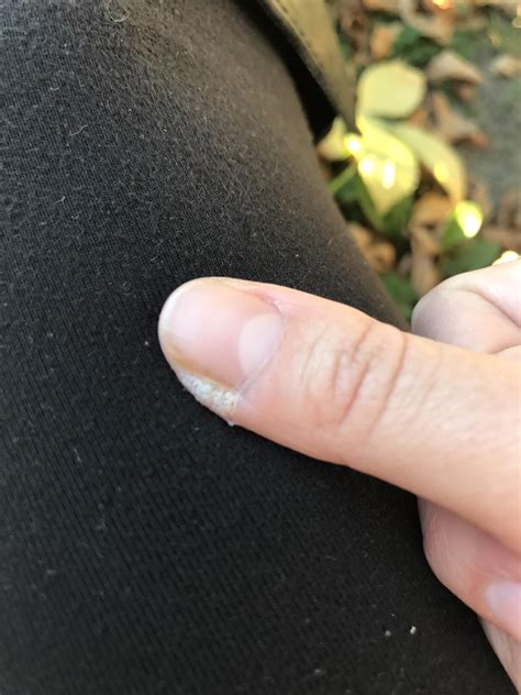 Repeat this remedy once or twice daily for best result. Dry Skin On Fingers Near Nails - NailsTip