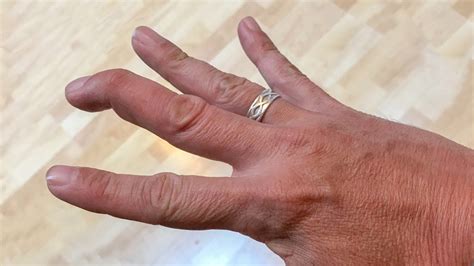 Mallet Finger Causes Symptoms And Treatment
