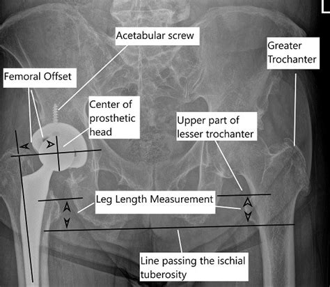 Leg Length Discrepancy After Hip Replacement Complete Orthopedics