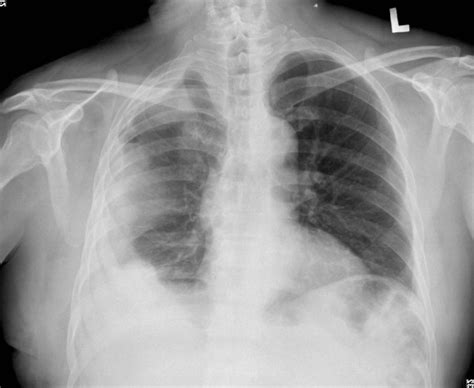If none is present the fluid is virtually always a transudate. Chest roentgenogram. Plain chest film showed right-side ...