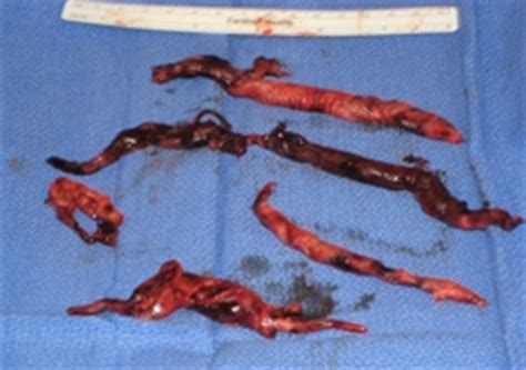 The catheter is then left in place for 12 to 24 hours while a steady infusion of medicine is delivered directly into the clot to help it dissolve. Pulmonary Embolic Disease | Columbia University Department ...