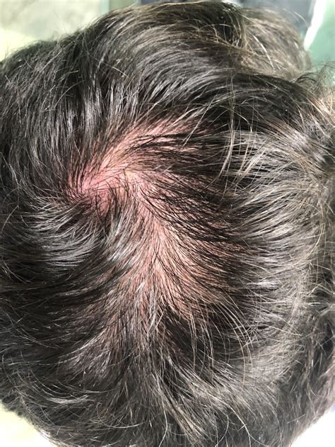 Alopecia Adrian Imbernon Derma