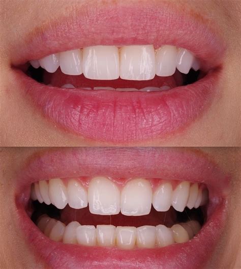 A Smile Make Over With Cosmetic Bonding Of Only 4 Teeth A Perfect Yet