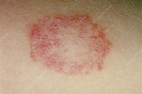 Ringworm Stock Image C0034312 Science Photo Library