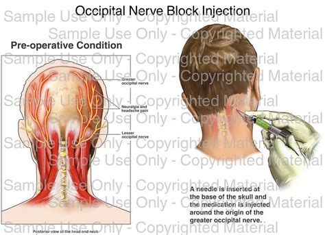 Loading Occipital Nerve Block Injection Please Wait Natural