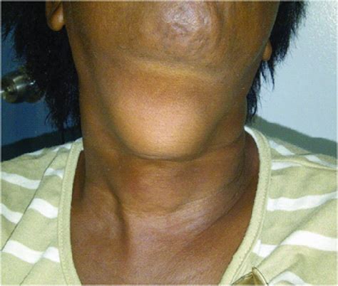 Anterior View Of The Neck Of The Patient Showing A Large Midline Neck