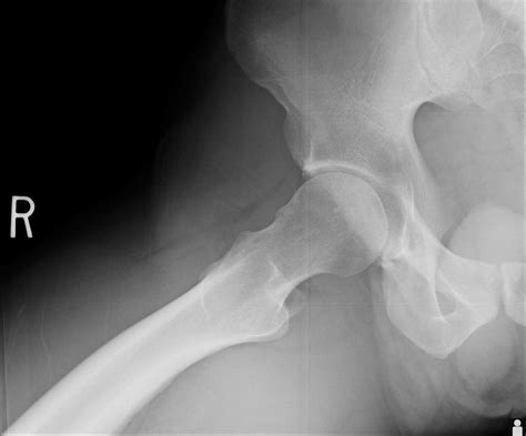 Femoroacetabular Impingement Fai Hip Specialist Santa Barbara