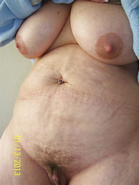 Scarred Stretched And Saggy Bellies 70 Pics Xhamster