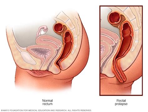 Solitary Rectal Ulcer Syndrome Symptoms And Causes